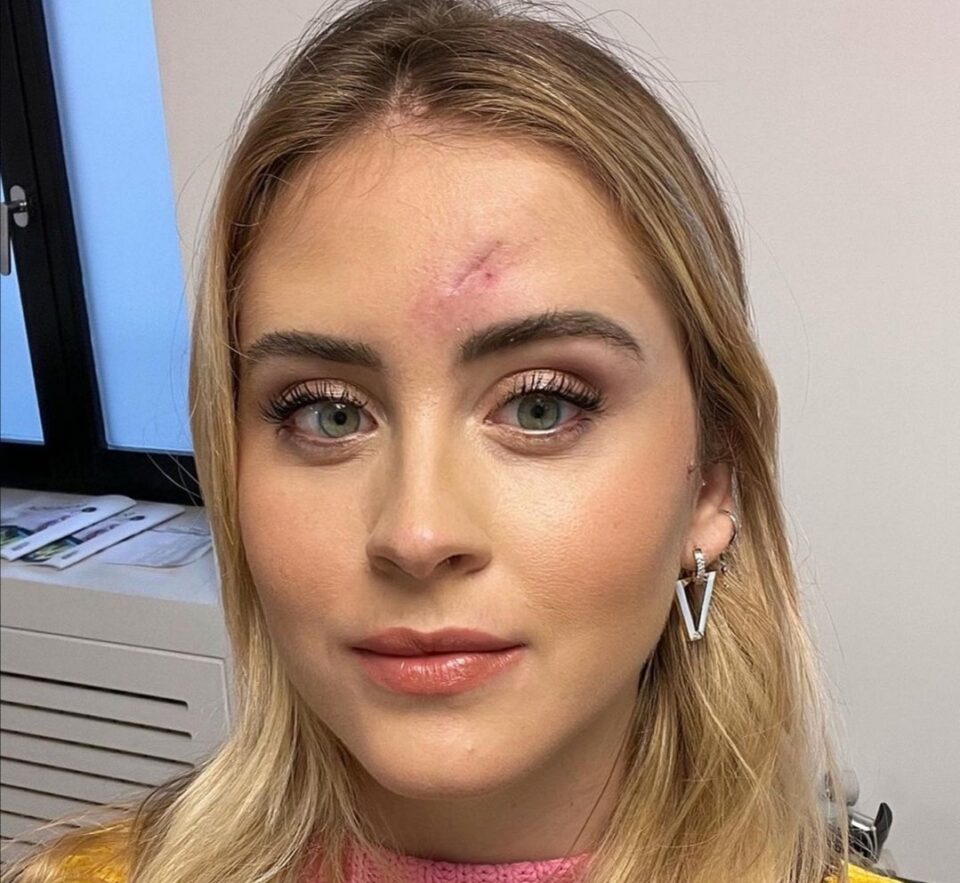 Valentina Ferragni dopo l'operazione : «Era un tumore maligno della pelle»